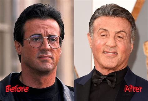 Did Sylvester Stallone Have Plastic Surgery? Exploring the Rumors and Realities