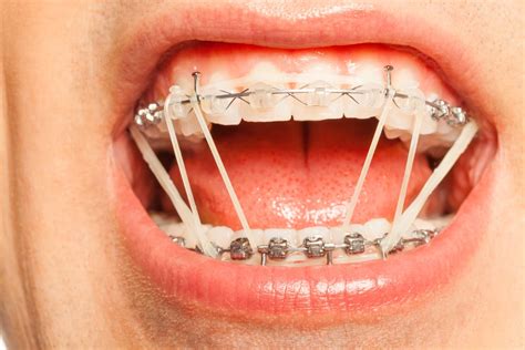 Why Do You Wear Rubber Bands with Braces: A Journey Through Orthodontic Oddities and Cosmic Connections